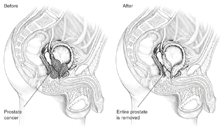 Radical prostate removal surgery