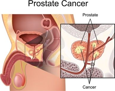 prostate-cancer-diagram