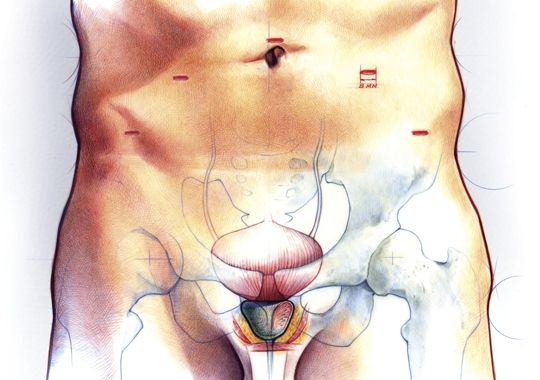 prostate cancer explained